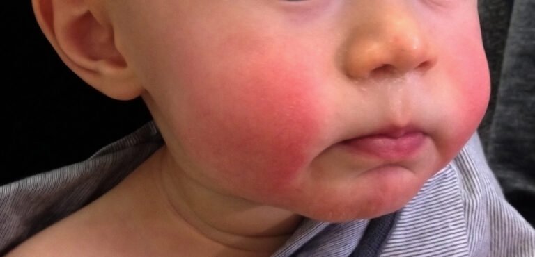 Erythema infectiosum Image by Wikimedia Commons